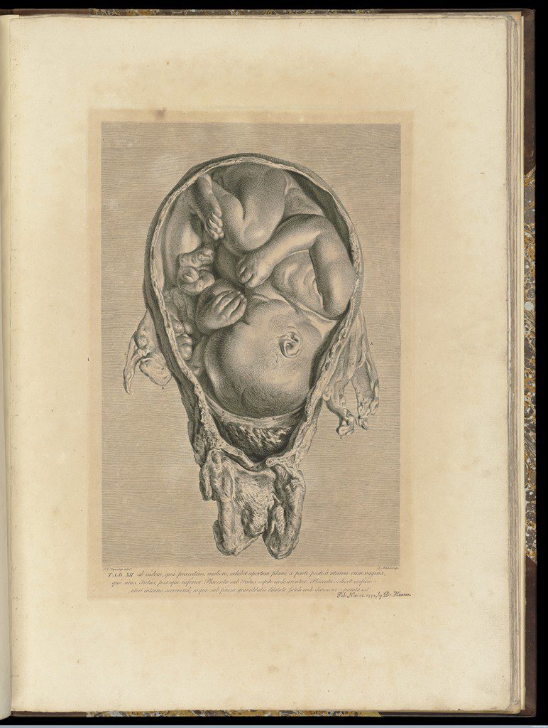 William Hunter, Anatomia Uteri Humani Gravidi Tabulis Illustrata / The anatomy of the human gravid uterus exhibited in figures…, by William Hunter, Physician Extraordinary to the Queen, Professor of Anatomy in the Royal Academy, and Fellow of the Royal and Antiquaries Societies (1774) The Royal Society, London [Shown : plate XII]
